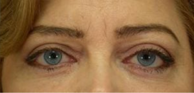 Closeup of a female with tighter skin that emphasizes her upper eyelids and firmer under eye skin after blepharoplasty