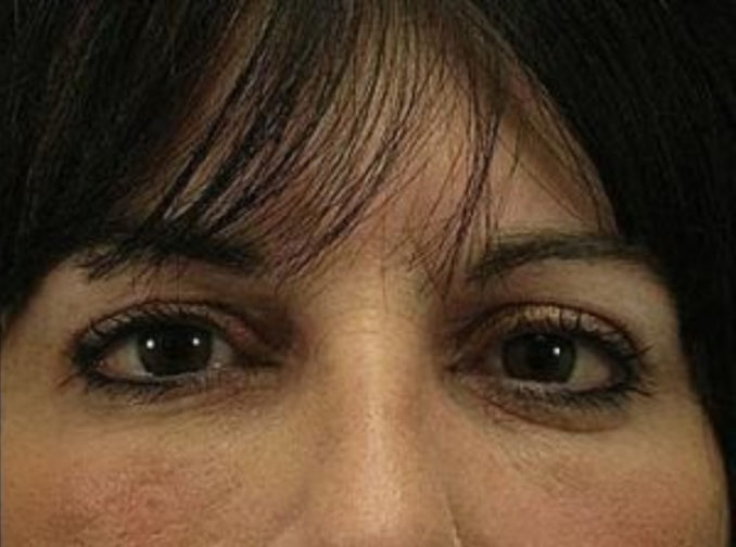 Closeup of a female with black hair showing firm and tight skin below her lower eyes after a blepharoplasty surgery