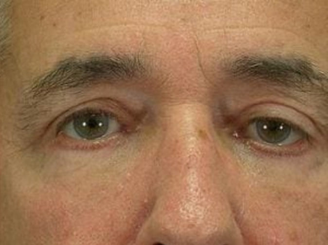 Closeup of a male with tight upper eyelid skin and smooth lower eyelids for younger look after blepharoplasty surgery