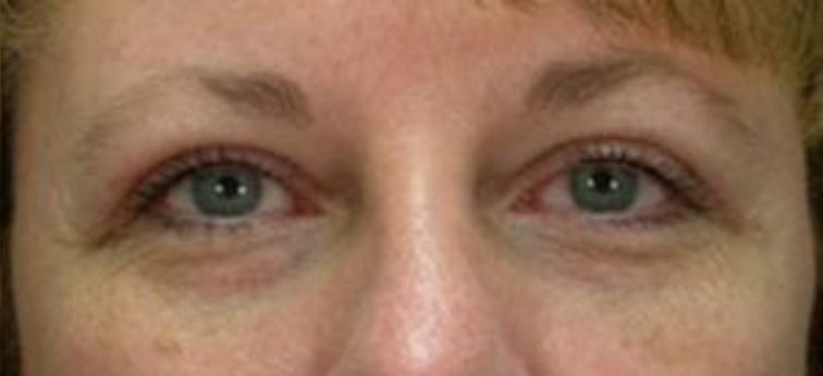 Closeup of female with less upper eye skin, tight lower eye skin, and visible eyelashes after blepharoplasty surgery