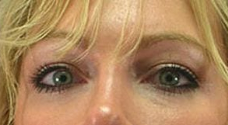 Closeup photo of a female with blue eyes showing tighter and firmer skin in her under eyes after a facial fat transfer