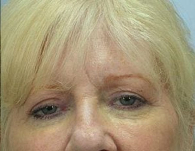 Closeup of a female with blonde hair showing firm skin on her upper and lower eyelids after facial fat transfer surgery