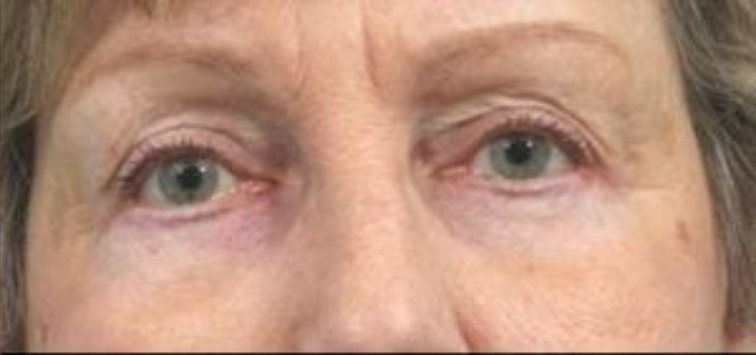 Closeup of an elderly female showing tightened skin in her eyes and jowls after facial fat transfer plastic surgery