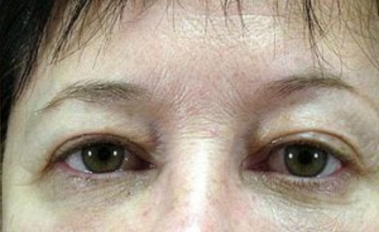 Closeup of a female with brown hair showing smooth and firm skin underneath her eyes after facial fat transfer surgery