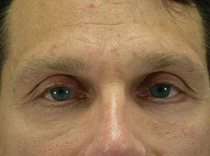 Closeup of a male showing visible smooth facial skin and under eye skin after a facial fat transfer plastic surgery