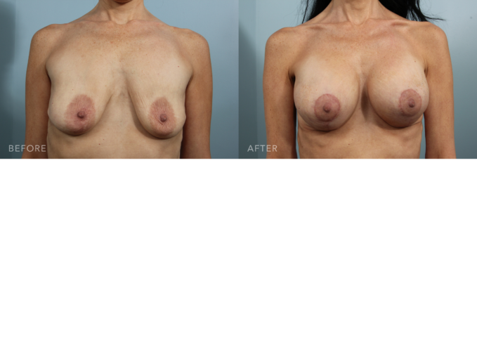 A photo of a woman's body before and after the Breast Lift with Augmentation procedure. The before photo shows stretched breast skin with wrinkles, laxity, and stretch marks. The after photo shows tighter and smoother breast skin, reducing the appearance of previous sagging and wrinkling. | Albany, Latham, Saratoga NY, Plastic Surgery