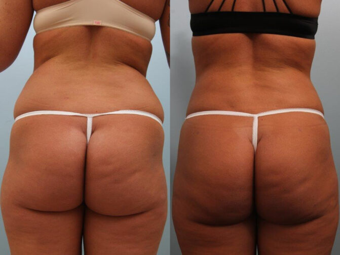 Patient showing before and after undergoing Brazilian butt lift surgery