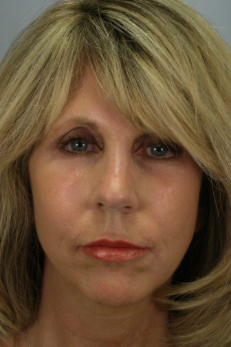 Closeup of blonde female after a weekend facelift procedure showing restored jowl structure