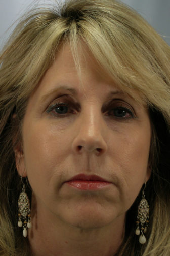 Closeup of blonde female before a weekend facelift procedure showing deep jowl lines and wrinkles