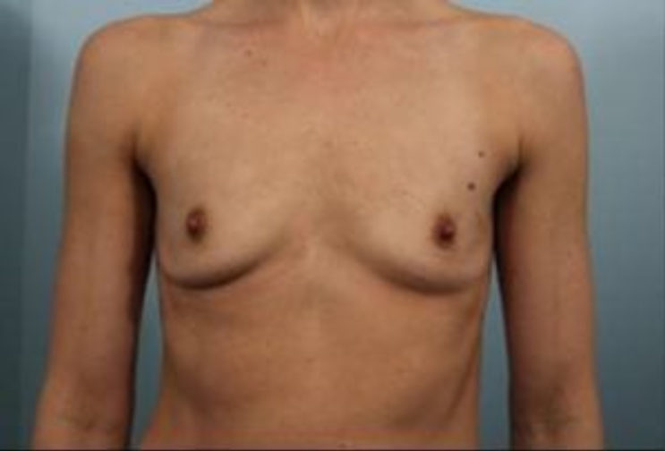 Closeup of a female showing flat-chested breasts before having breast augmentation and implant plastic surgery