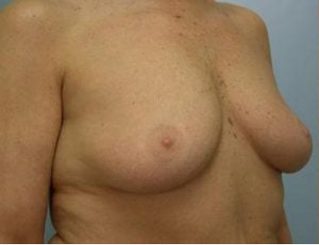 Closeup of a female showing flattened breast tissue and loose skin before having breast augmentation plastic surgery