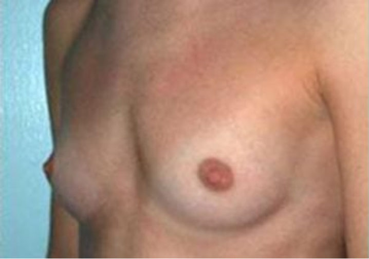 Closeup of a female showing a flat chest before breast augmentation and implant plastic surgery