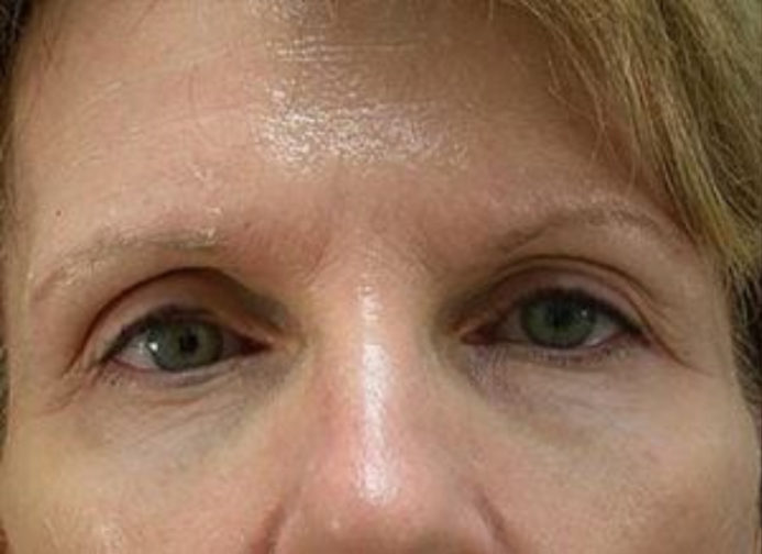 Close-up of elderly blonde female showing heavy upper brow and loose under-eye skin before blepharoplasty procedure