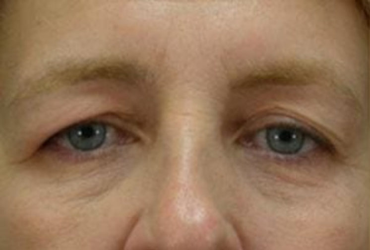 Closeup of a female showing extra skin on her upper eyelid covering her eyelashes before a blepharoplasty surgery