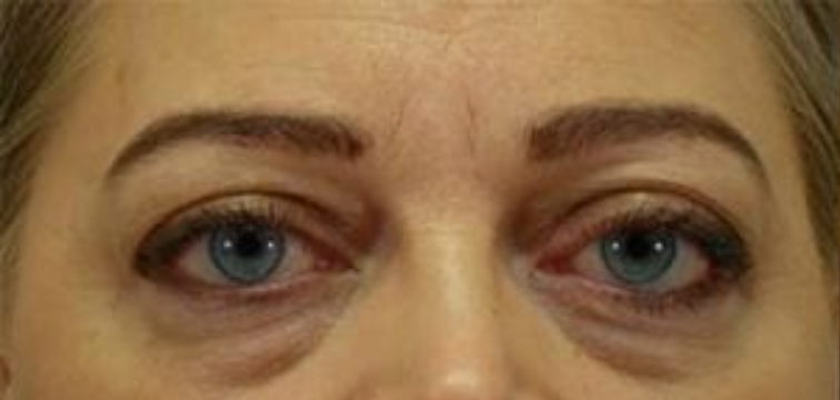 Closeup of a female with excess upper eyelid skin and baggy lower eyelid skin before a blepharoplasty surgery
