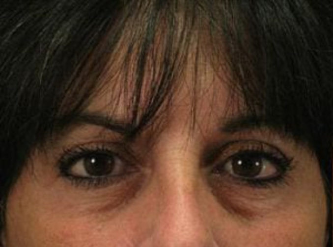 Closeup of a female with black hair showing puffy lower eyelids and visible wrinkles before a blepharoplasty surgery