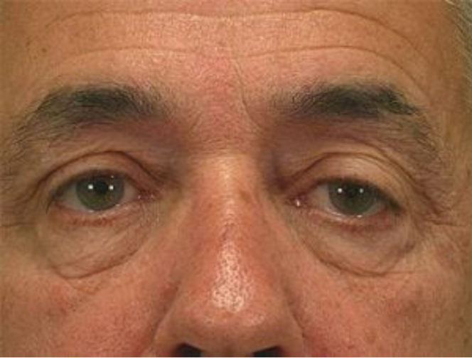 Closeup of a male with loose skin in his upper and lower eyelids with wrinkles before a blepharoplasty surgery