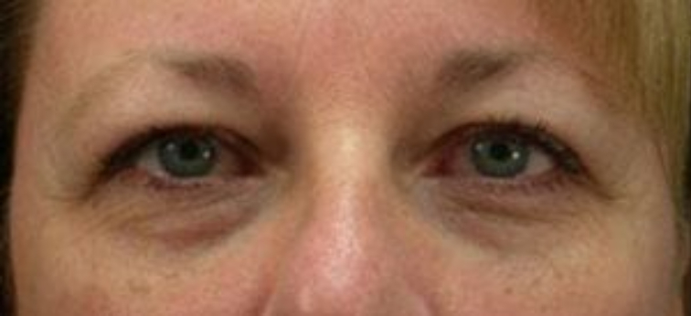 Closeup of a female showing a heavy brow and excess skin on her upper eye before a blepharoplasty plastic surgery