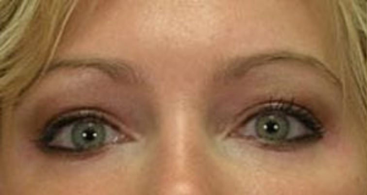 Closeup of a female before having facial fat transfer plastic surgery with puffy, enlarged skin under her lower eyelids