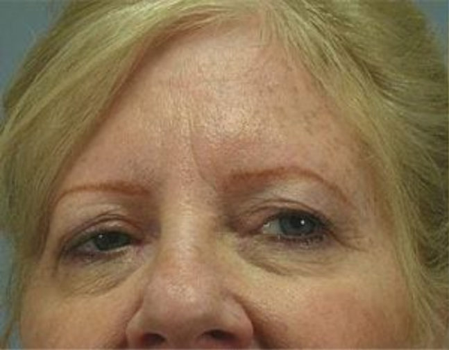 Closeup of a blonde female with loose skin on her upper eyelids with visible wrinkles before facial fat transfer surgery