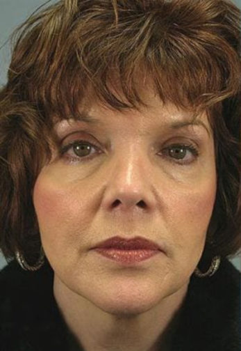 Closeup of brunette female wearing a black jacket showing visible under eye wrinkles before facial fat transfer surgery