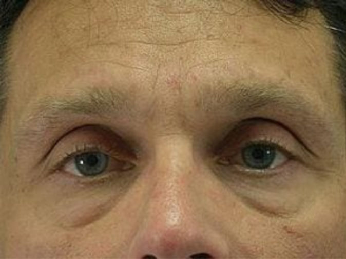 Closeup of a male with excess skin under his eyes before having a facial fat transfer plastic surgery procedure