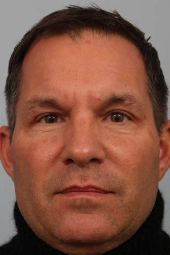 Close-up of male wearing turtle neck shirt showing tighter skin on his upper eyelid after a blepharoplasty procedure