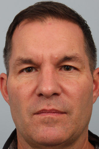 Close-up of a male wearing a black shirt showing droopy upper eyelid skin before a sliver blepharoplasty procedure