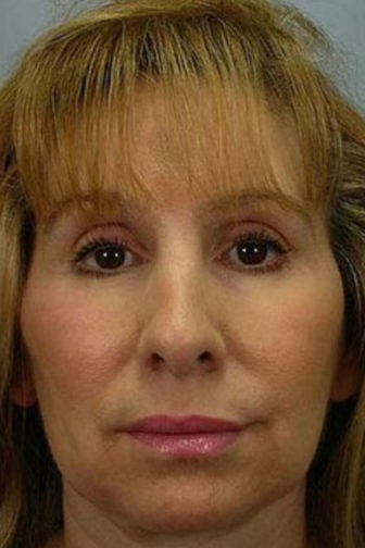 Close-up of a female showing tightly compressed skin below her eyes and around her cheeks after blepharoplasty procedure