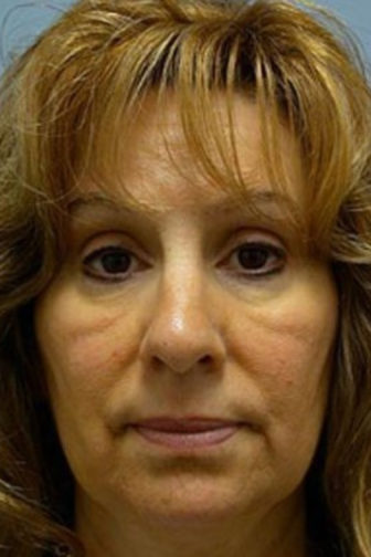 Close-up of female with dark blonde hair showing puffy, sagging skin around her cheeks before blepharoplasty procedure