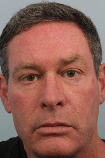 Close-up of a male wearing a black shirt with tighter, younger-looking under-eye skin after a blepharoplasty procedure