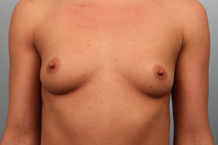 Closeup of a female's chest showing droopy and flat breasts before a breast augmentation plastic surgery