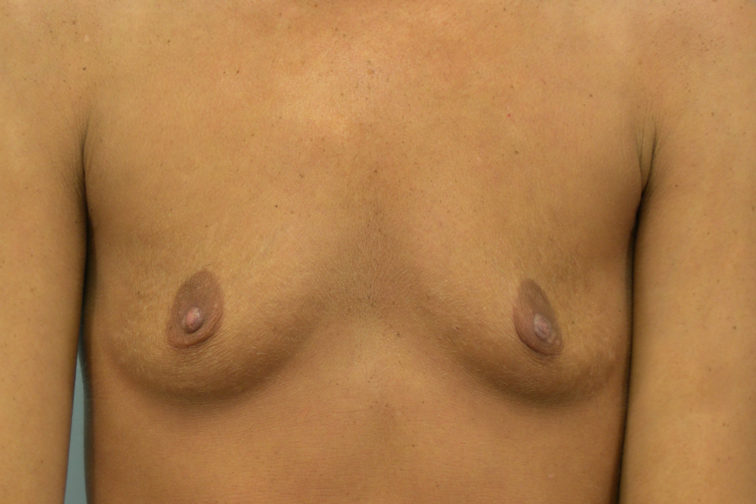 Closeup of a female showing a sagging appearance of her breasts before having breast augmentation surgery