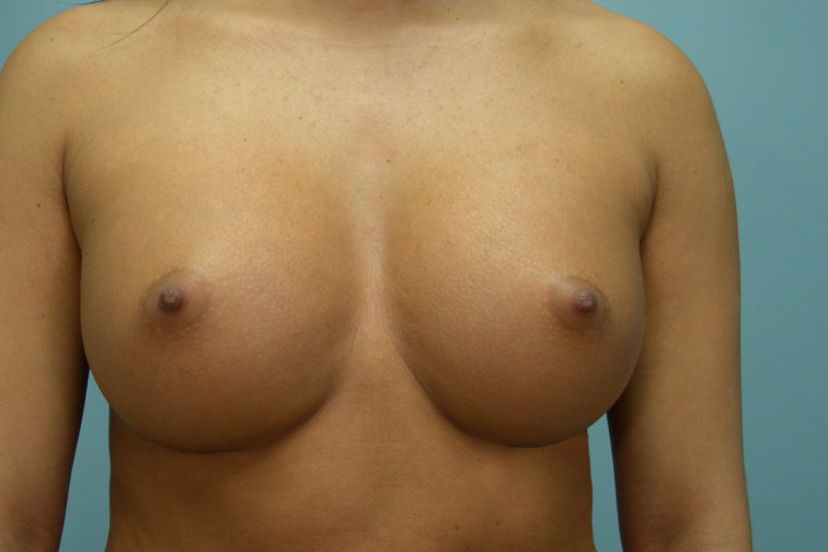 Closeup of a female body showing the result of having breast augmentation surgery