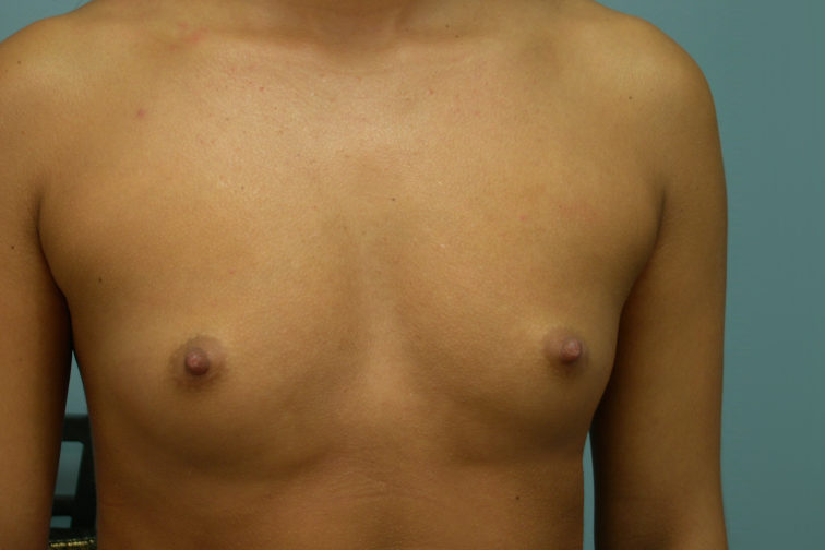 Closeup of a female's body showing smaller breasts before breast augmentation surgery