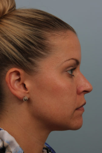 Side profile of a female with blonde hair showing a smooth nasal tip after rhinoplasty surgery