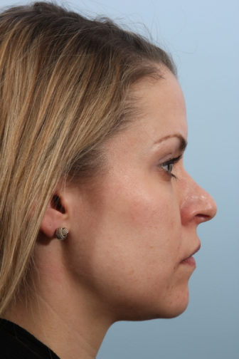 Side profile of a female with blonde hair showing a crooked nasal tip before rhinoplasty surgery