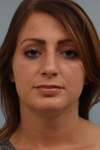 Closeup of a female showing a straightened and upright angle of her nose after an endonasal rhinoplasty surgery