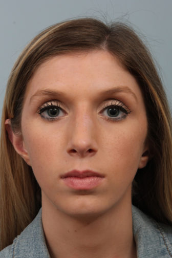 Closeup of a teenage female wearing denim jacket showing angled nose and straight columella after rhinoplasty surgery
