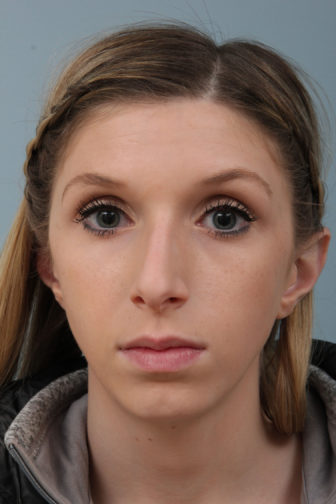 Closeup of a teenage female wearing gray jacket showing crooked nose and hanging columella before rhinoplasty surgery
