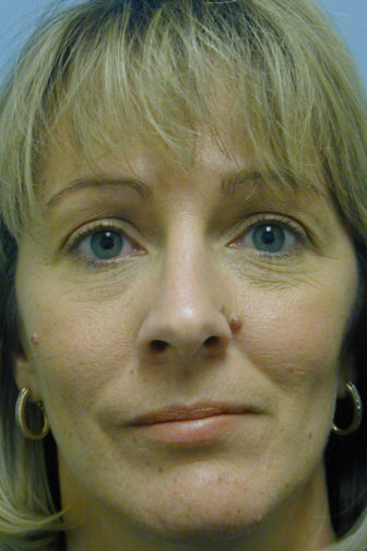 Closeup of a female with blonde hair, wearing gold earrings, showing a straightened appearance of her nose after a rhinoplasty surgery