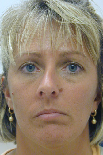 Closeup of a female with blonde hair, wearing gold earrings, showing a crooked appearance of her nose on the left side before a rhinoplasty surgery