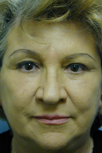 Closeup of an elderly female showing tighten skin on her forehead after an endoscopic brow lift surgery