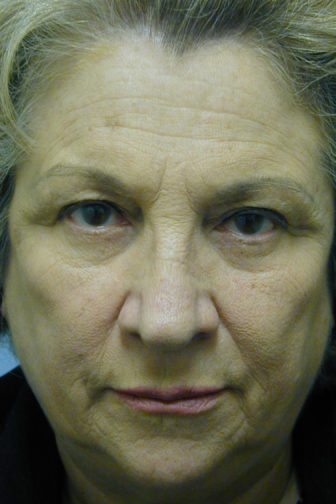 Closeup of an elderly female showing visible wrinkles between her brows and forehead area before an endoscopic surgery