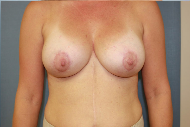 Closeup of a female showing tightened and well-rounded breasts after breast augmentation with implants plastic surgery