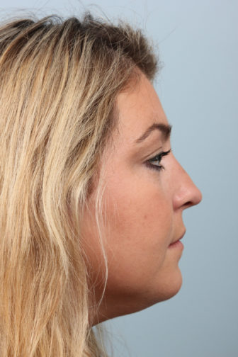 Side profile of a teenage female with blonde hair showing a feminine nose after rhinoplasty surgery