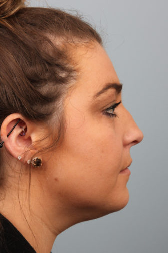 Side profile of a teenage female with brown hair showing a droopy nose before rhinoplasty surgery