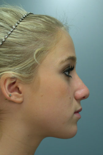 Side profile of a 21 year old female before rhinoplasty surgery showing a smooth tip with restored cartilage