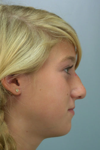 Side profile of a 21 year old female before rhinoplasty surgery showing a bulbous tip and loss of height