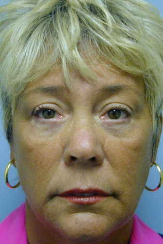 Closeup of a female showing firm skin on her upper and lower eyelids after an endoscopic forehead and midface lift surgery